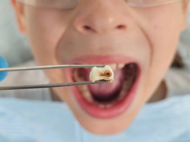Best Emergency Broken Tooth Repair in Big Lake, TX
